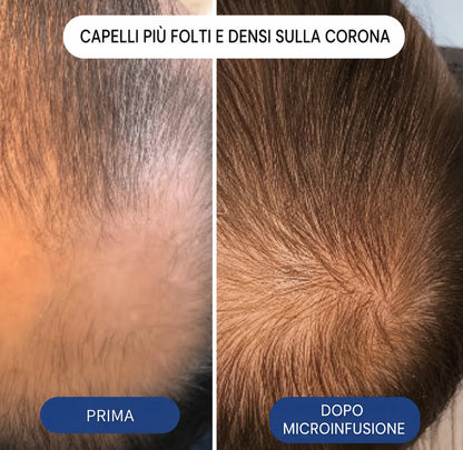 Il più potente sistema di ricrescita dei capelli con infusione di peptidi